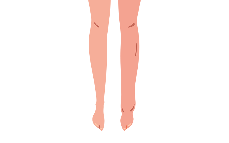 Legs showing slight swelling around the ankles. Legs showing slight swelling around the ankles.